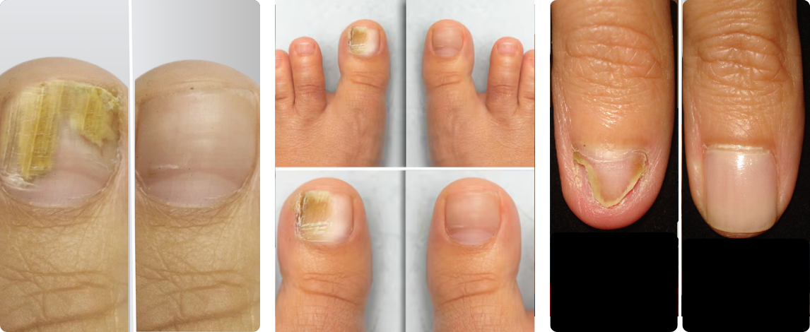 toenail fungus 3
