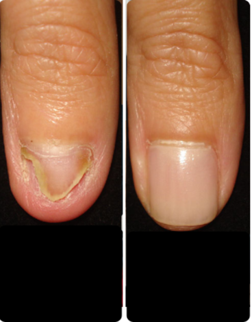 toenail fungus case 3