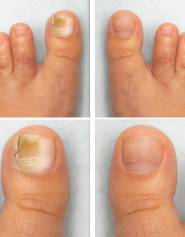 toenailfungus case 4