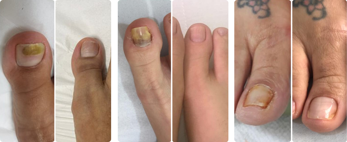 toenail fungus cases 1