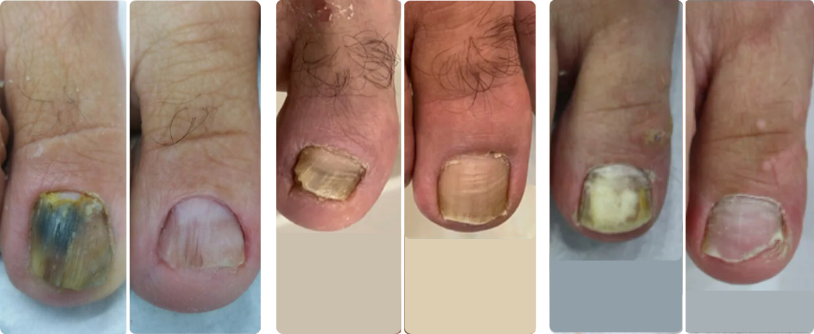 toenail fungus cases 2