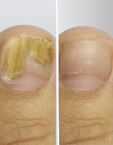 toenail fungus case 6