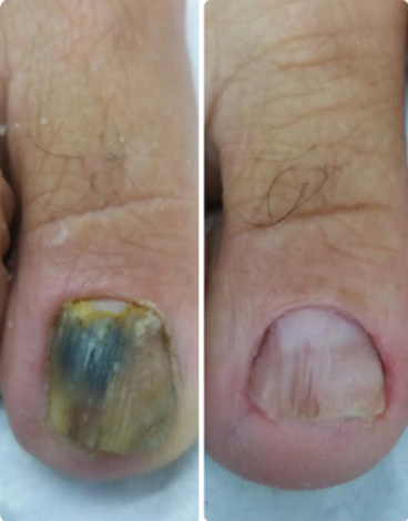 toenail fungus case 5