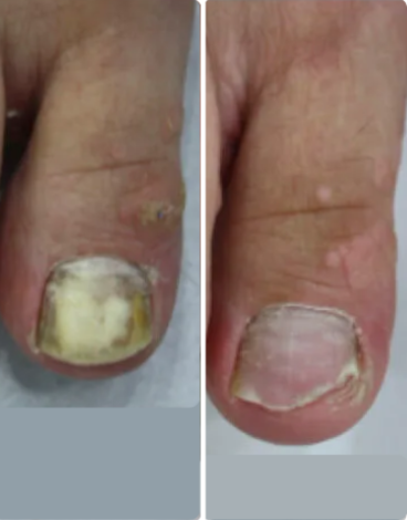 toenail fungus case 7