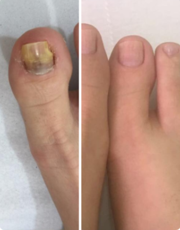 toenail fungus case 8