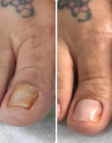 toenail fungus case 9
