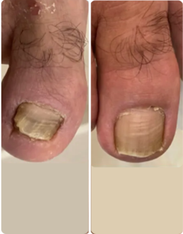 toenail fungus case 10
