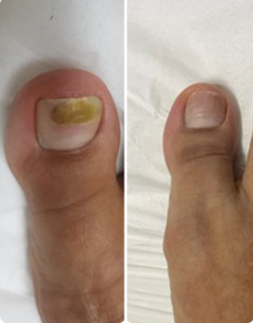toenail fungus case 11